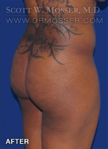 Brazilian Butt Lift Patient 86378 After Photo # 4