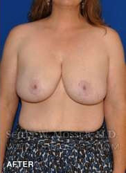 Breast Reduction Patient 97519 After Photo # 8