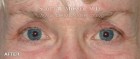 Upper Blepharoplasty Patient 93893 After Photo Thumbnail # 2