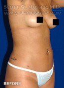 Liposuction - Abdomen & Flanks Patient 53811 Before Photo Thumbnail # 3