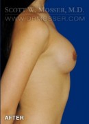 Breast Augmentation Patient 50236 After Photo Thumbnail # 6