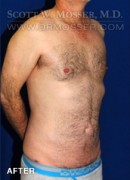 Liposuction - Abdomen & Flanks Patient 23232 After Photo Thumbnail # 10
