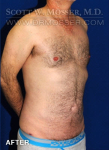 Liposuction - Abdomen & Flanks Patient 23232 After Photo # 10