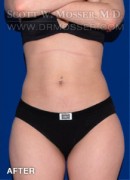 Liposuction - Thighs Patient 97167 After Photo Thumbnail # 2