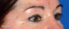Upper Blepharoplasty Patient 79210 Before Photo Thumbnail # 3