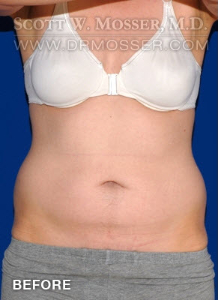 Liposuction - Abdomen & Flanks Patient 75438 Before Photo # 1