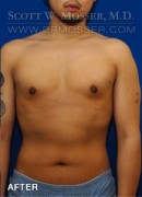 Liposuction - Chest Patient 38439 After Photo Thumbnail # 2