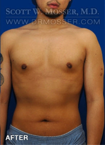 Liposuction - Chest Patient 38439 After Photo # 2