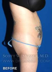 Liposuction - Abdomen & Flanks Patient 81638 Before Photo # 7