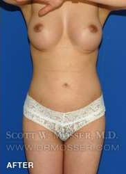 Liposuction - Thighs Patient 89876 After Photo # 4