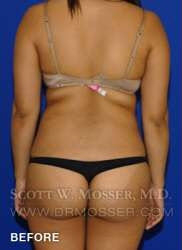 Liposuction - Abdomen & Flanks Patient 33709 Before Photo # 11
