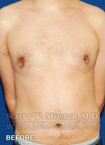 Liposuction - Chest Patient 34240 Before Photo # 1