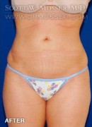 Liposuction - Abdomen & Flanks Patient 39576 After Photo Thumbnail # 2