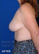 Breast Reduction Patient 97519 After Photo Thumbnail # 10