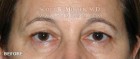 Lower Blepharoplasty Patient 38290 Before Photo Thumbnail # 1