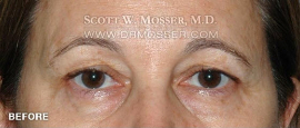 Lower Blepharoplasty Patient 38290 Before Photo # 1