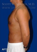Liposuction - Chest Patient 51212 After Photo Thumbnail # 6