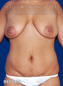 Mommy Makeover Patient 49956 Before Photo # 1
