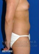 Liposuction - Abdomen & Flanks Patient 58519 Before Photo Thumbnail # 7