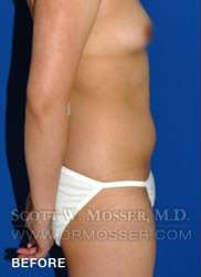 Liposuction - Abdomen & Flanks Patient 58519 Before Photo # 7