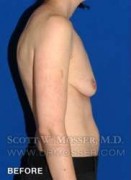 Breast Asymmetry Correction Patient 37996 Before Photo Thumbnail # 5