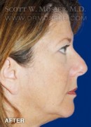 Upper Blepharoplasty Patient 20934 After Photo Thumbnail # 2