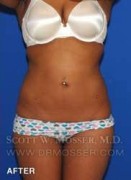 Liposuction - Abdomen & Flanks Patient 41506 After Photo Thumbnail # 2