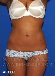 Liposuction - Abdomen & Flanks Patient 41506 After Photo # 2