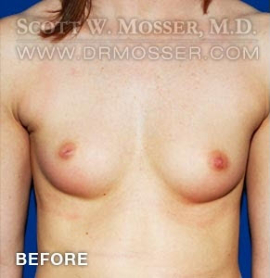 Breast Augmentation Patient 41756 Before Photo # 1