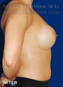 Breast Augmentation Patient 13760 After Photo # 6