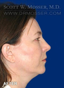Chin Implant Patient 16572 After Photo # 10