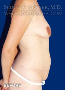 Mommy Makeover Patient 38394 Before Photo # 5