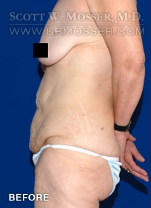 Lower Body Lift Patient 68424 Before Photo # 3