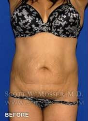 Liposuction - Abdomen & Flanks Patient 30590 Before Photo # 1