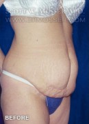 Abdominoplasty Patient 49869 Before Photo Thumbnail # 5