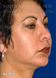 Chin Implant Patient 68063 After Photo # 4