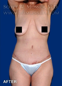 Lower Body Lift Patient 68424 After Photo # 2