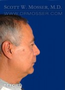 Upper Blepharoplasty Patient 77408 Before Photo Thumbnail # 3