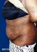 Abdominoplasty Patient 30014 Before Photo Thumbnail # 3