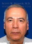 Upper Blepharoplasty Patient 77408 Before Photo Thumbnail # 1