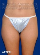 Liposuction - Thighs Patient 10722 After Photo Thumbnail # 4