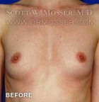 Breast Augmentation Patient 88566 Before Photo Thumbnail # 1