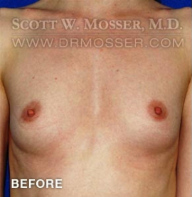 Breast Augmentation Patient 88566 Before Photo # 1