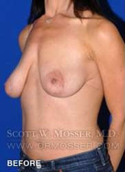 Breast Lift With Implants Patient 19074 Before Photo # 5