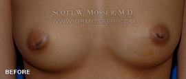 Nipple Inversion Correction Patient 38571 Before Photo # 1