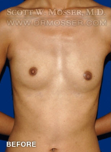 Breast Augmentation Patient 68907 Before Photo # 1