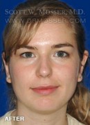 Otoplasty Patient 99547 After Photo Thumbnail # 2