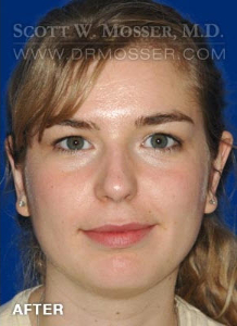 Otoplasty Patient 99547 After Photo # 2
