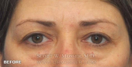 Brow Lift Patient 82649 Before Photo # 1
