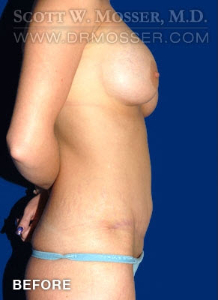 Abdominoplasty Patient 56801 Before Photo # 5